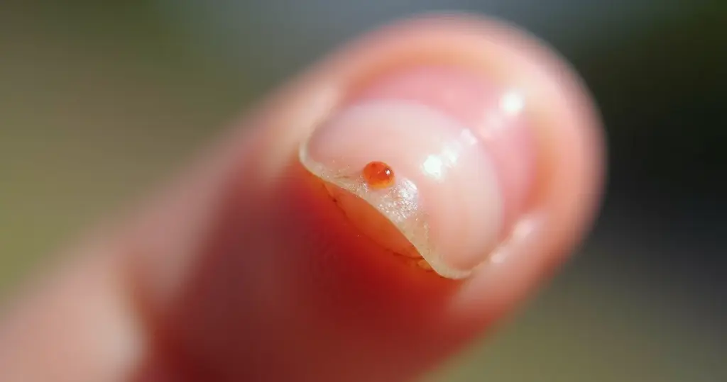 Unha com Pus: O Que Fazer e Como Tratar de Vez Unha com Pus: O Que Fazer e Como Tratar de Vez